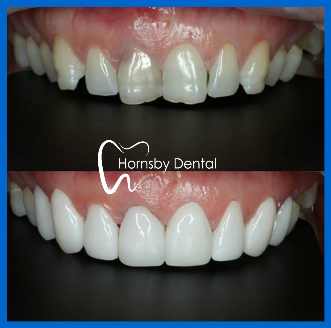 Dental Veneers Hornsby