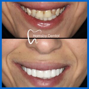 Best Porcelain Veneers in Hornsby