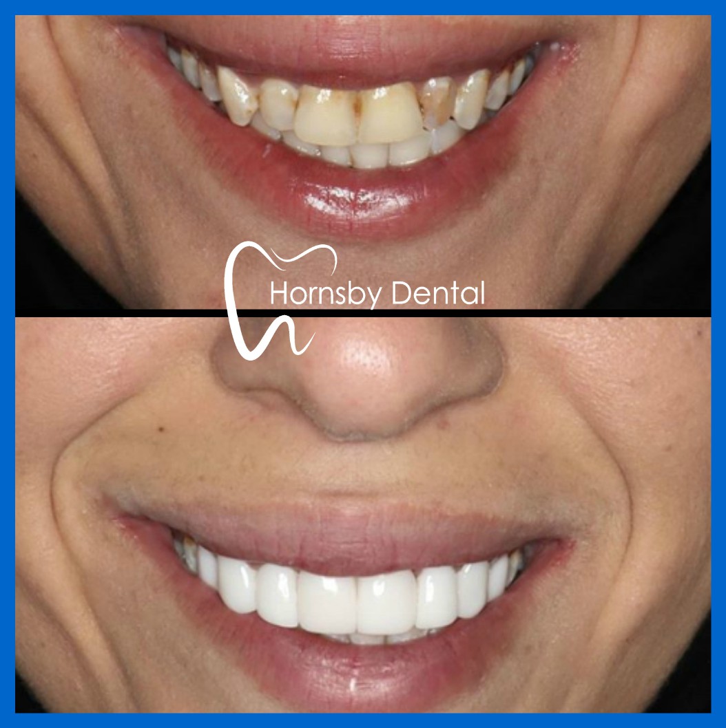 Best Porcelain Veneers in Hornsby