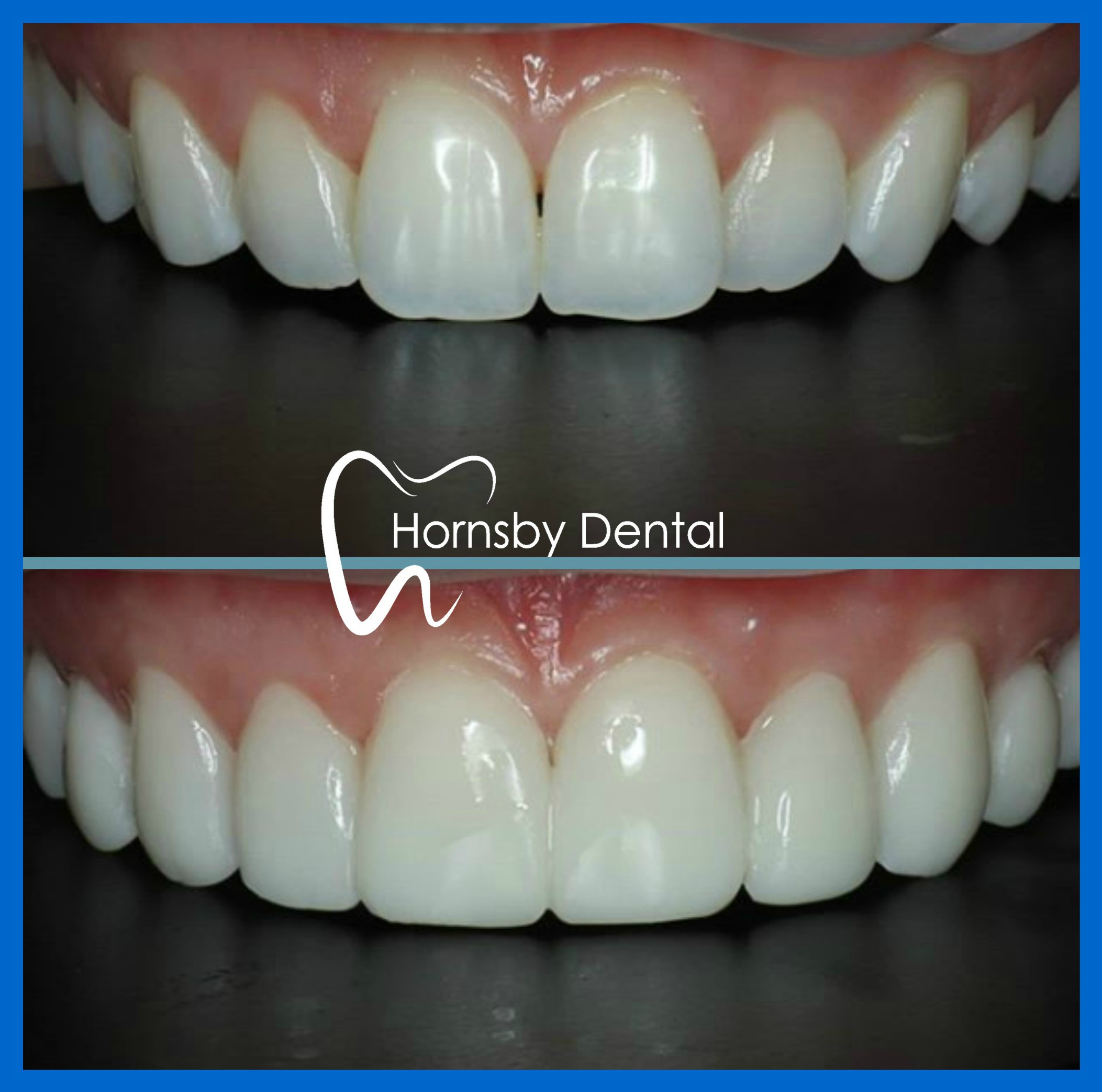 Veneers Hornsby