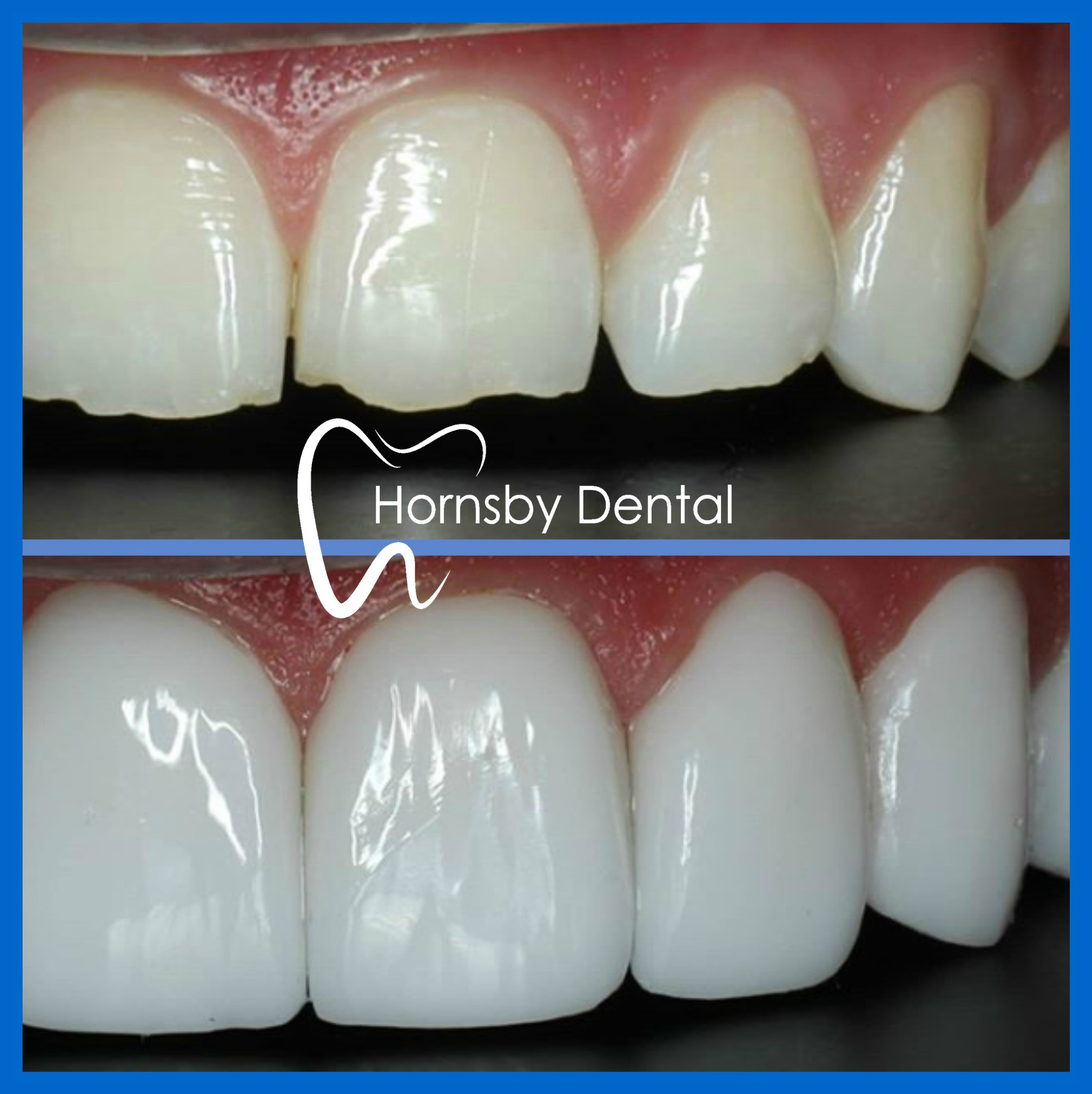 Teeth Veneers in Hornsby