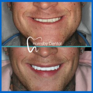 Porcelain Veneers Hornsby