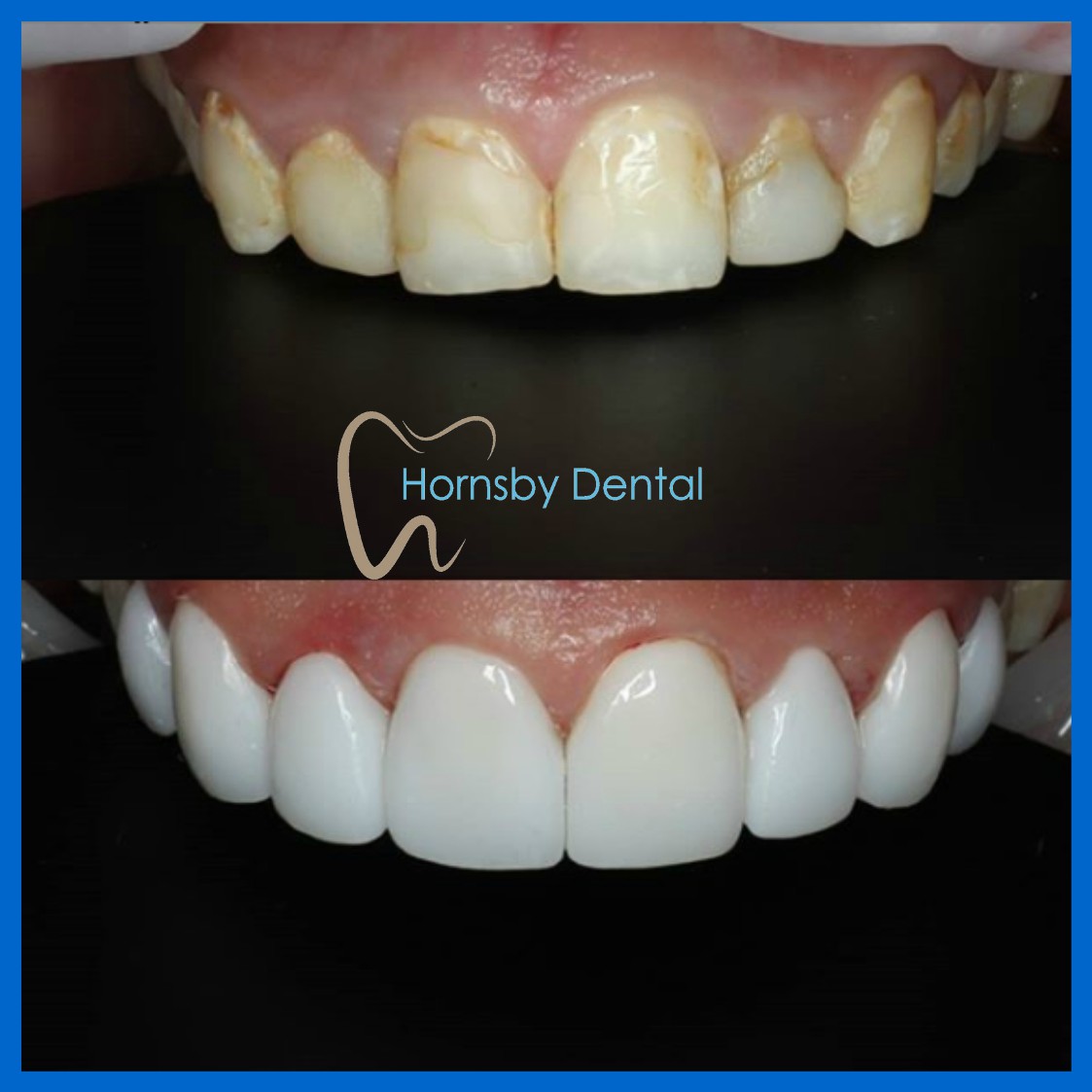 Dental Veneers in Hornsby