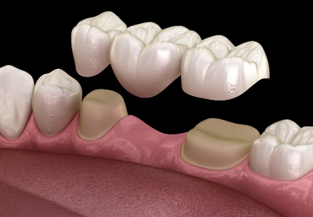 dental bridge