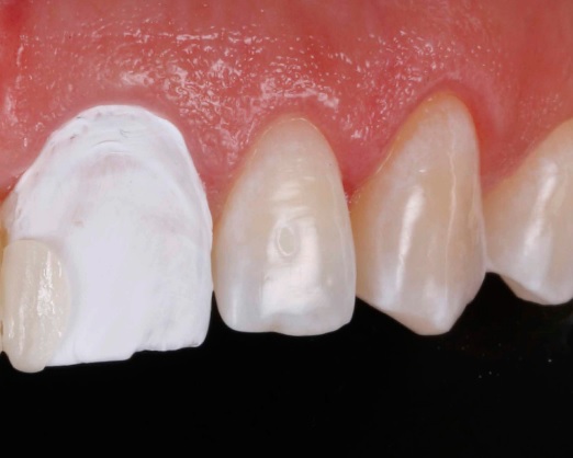 Composite veneers