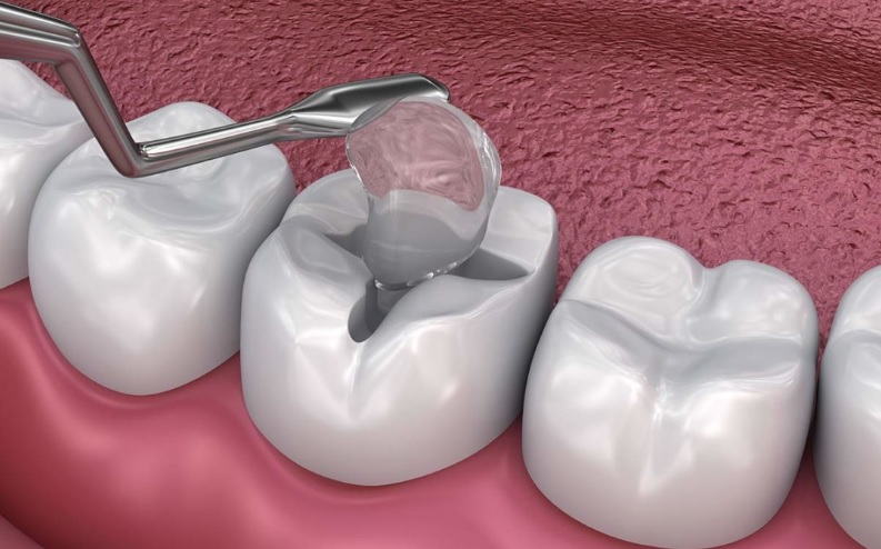Dental Filling | Hornsby Dentist | Hornsby Dental