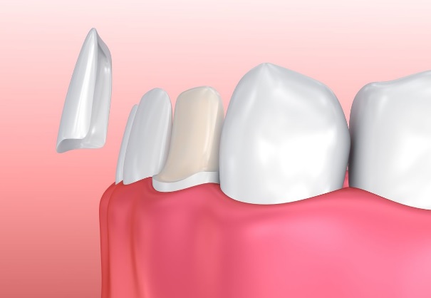 Dental Veneers Hornsby