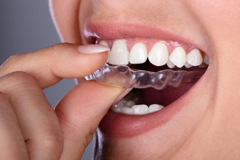 Invisalign Cost Sydney