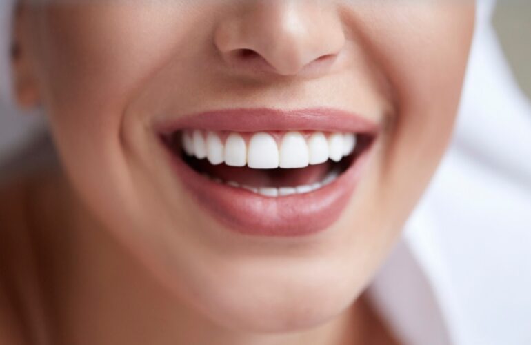 Veneers in Hornsby