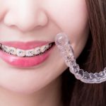 Invisalign vs Braces