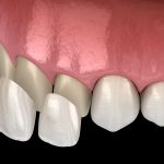 Veneers Teeth Pros and Cons