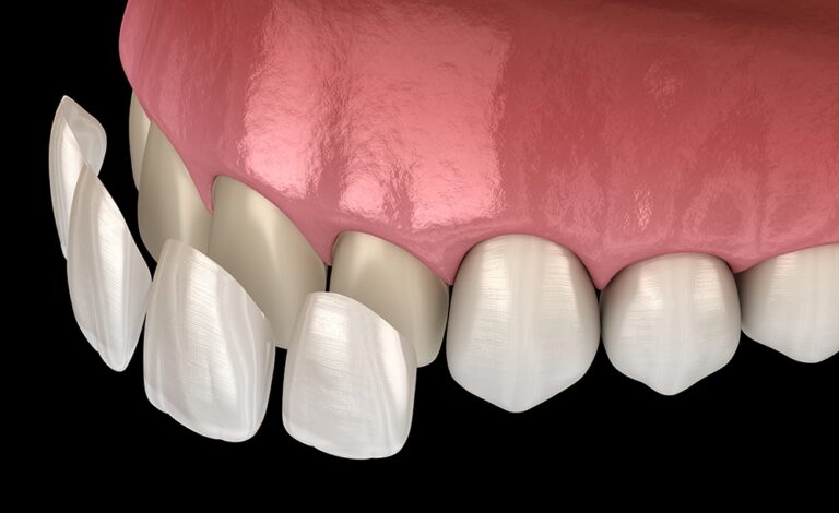 Veneers Teeth Pros and Cons