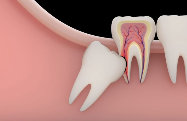 Wisdom Teeth Removal Sydney