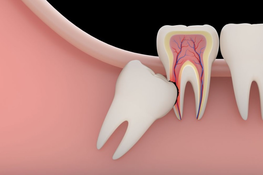 Wisdom Teeth Removal Sydney