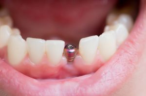 Dental Implant Cost