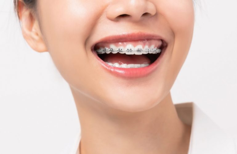 How Much Do Braces Cost