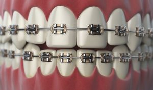 How Much Do Braces Cost