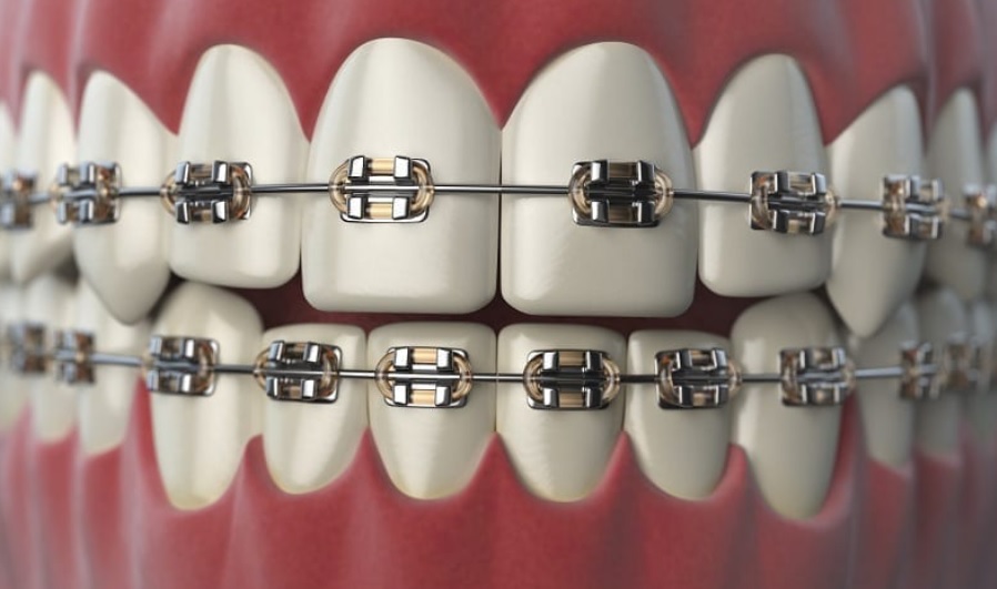 How Much Do Braces Cost?