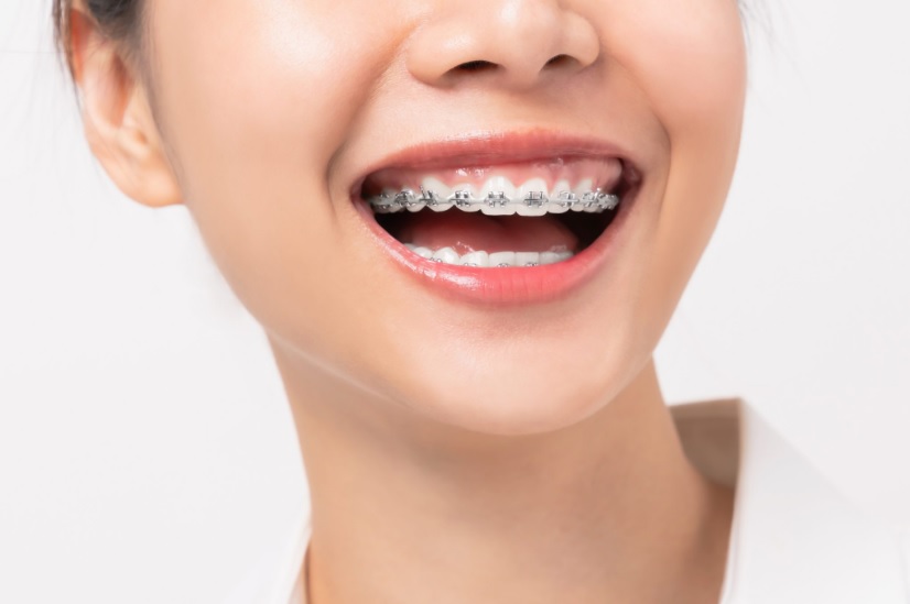 How Much Do Braces Cost