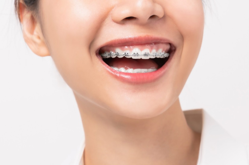 How Much Do Braces Cost?, Braces Price