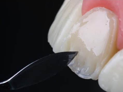 Composite Veneers Sydney