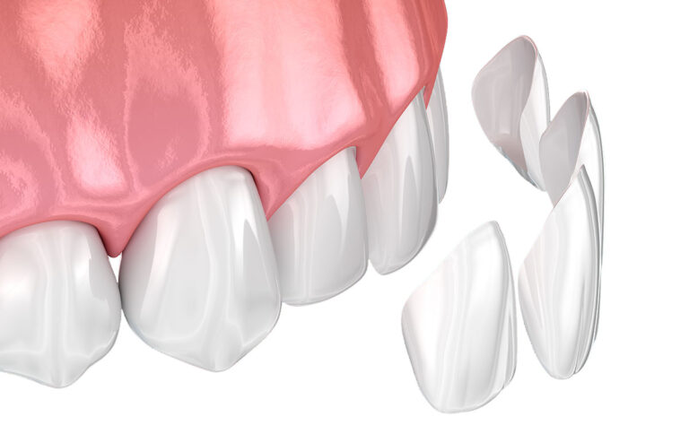What are veneers