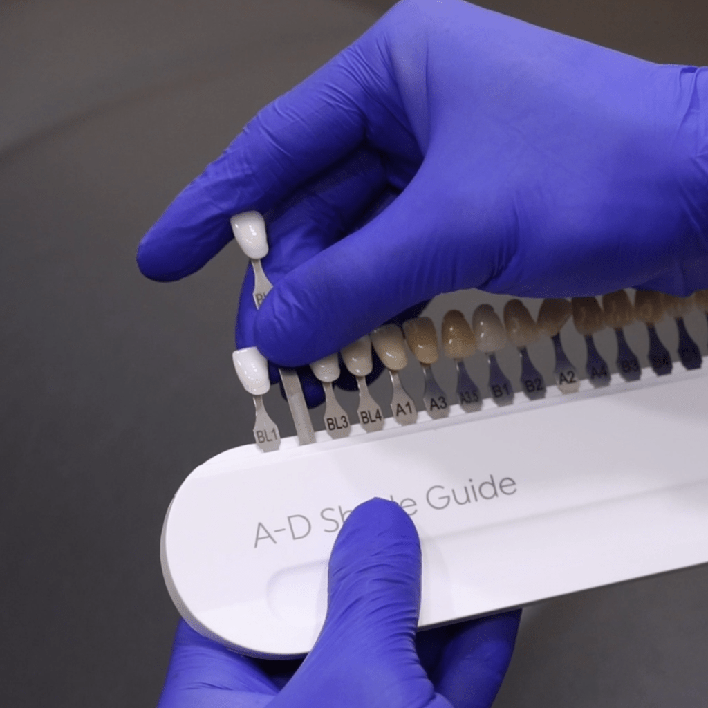 Composite Veneers in Hornsby