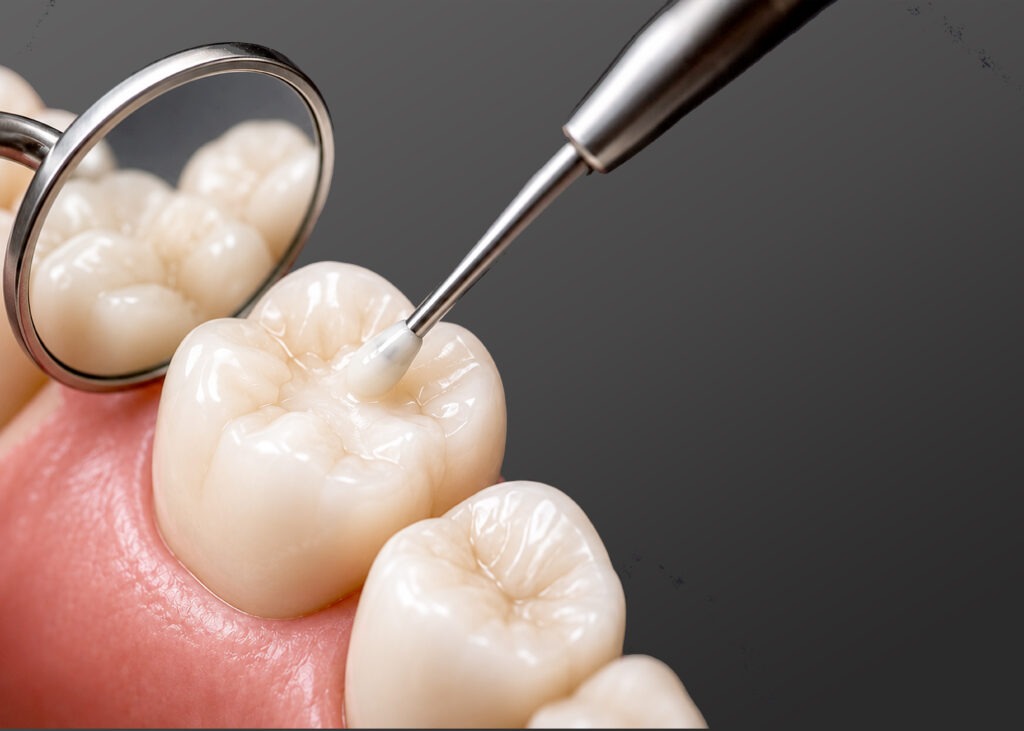 Tooth-coloured dental filling in Hornsby