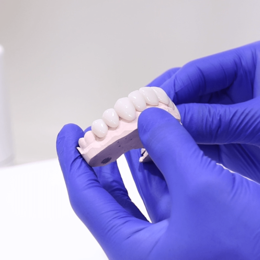 Porcelain veneers model at Hornsby Dental