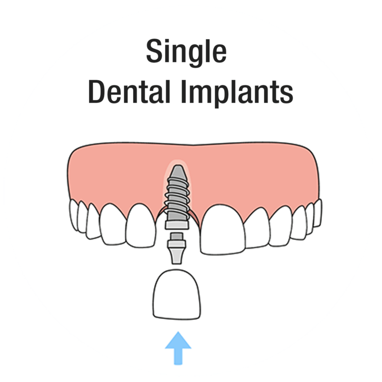 Single dental implant illustration