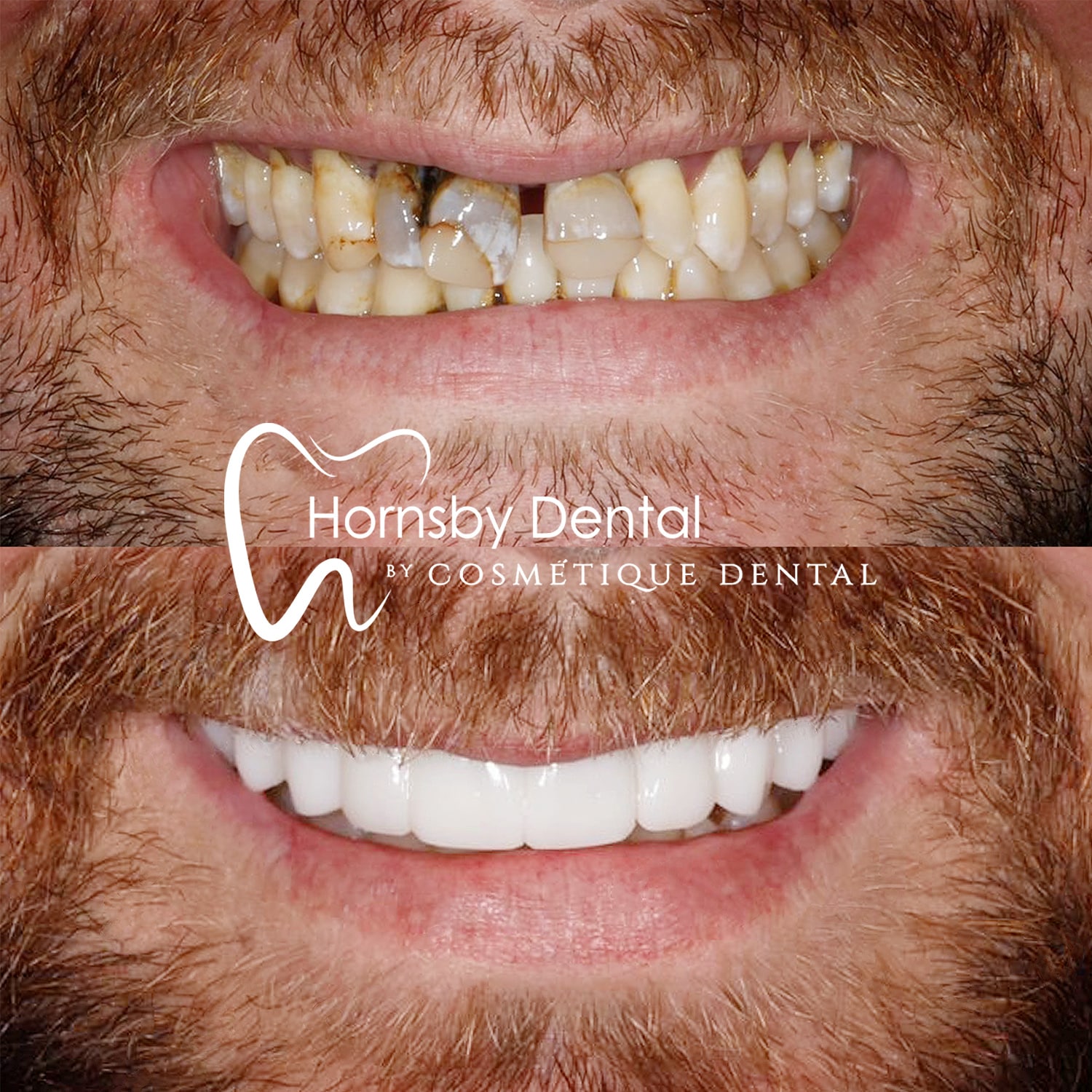 Dental Implant