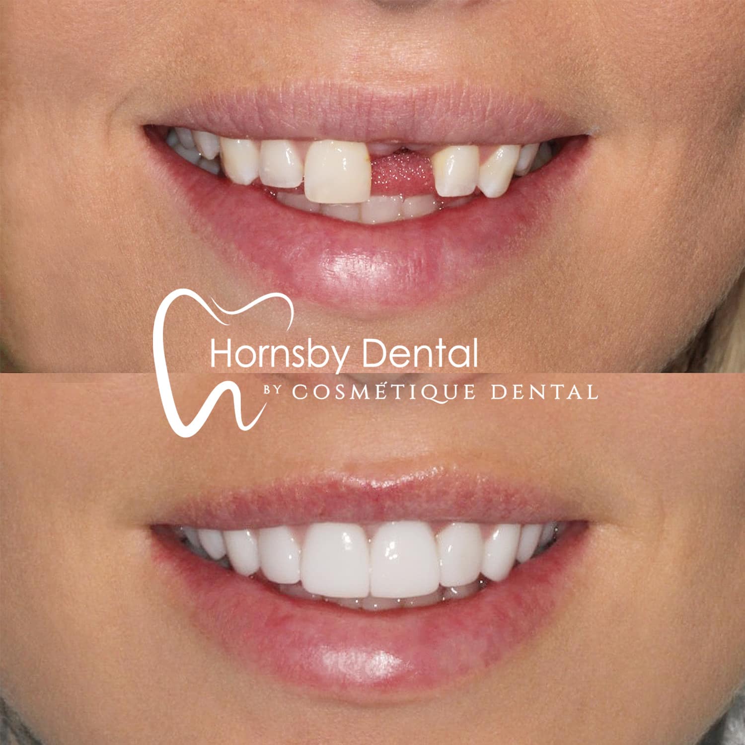 Dental Implant