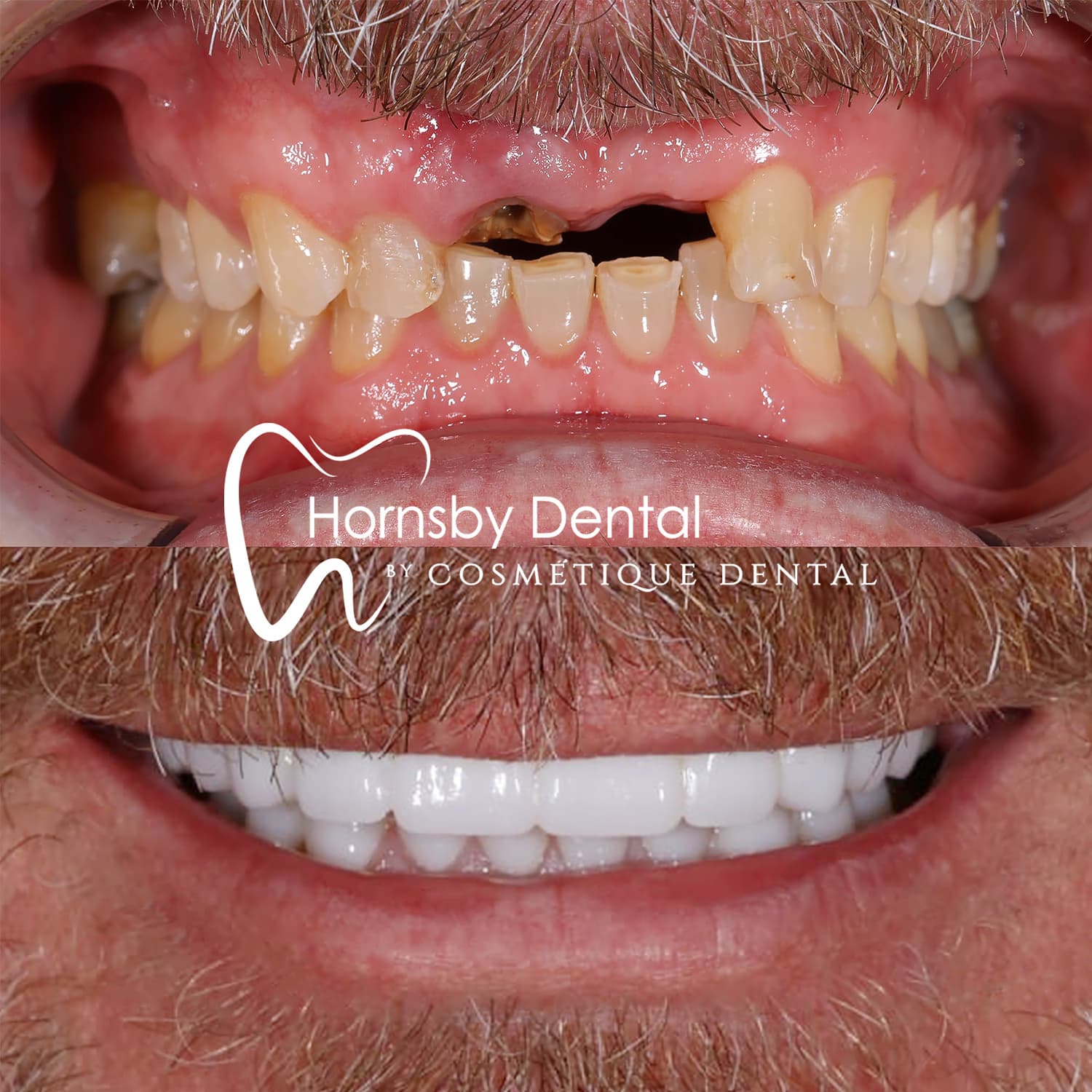 Dental Implant