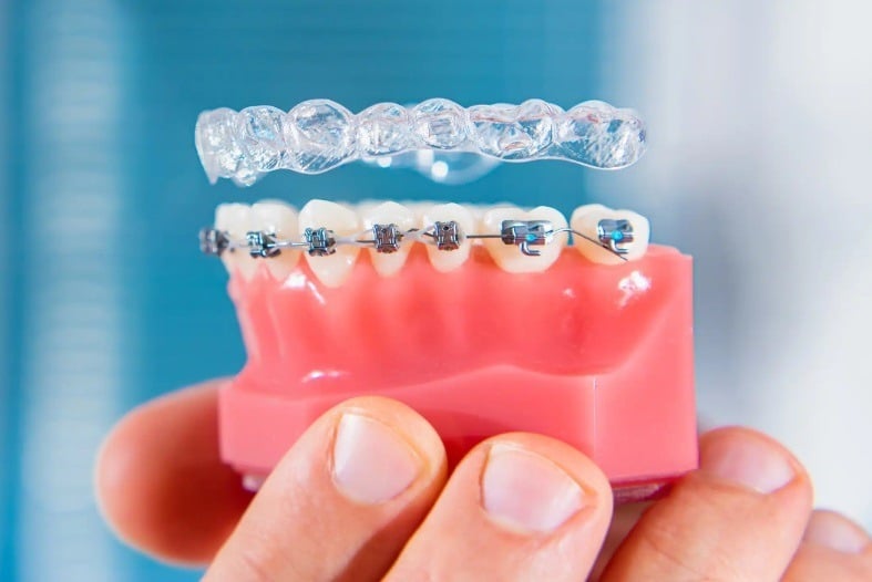 Invisalign clear aligners compared with braces