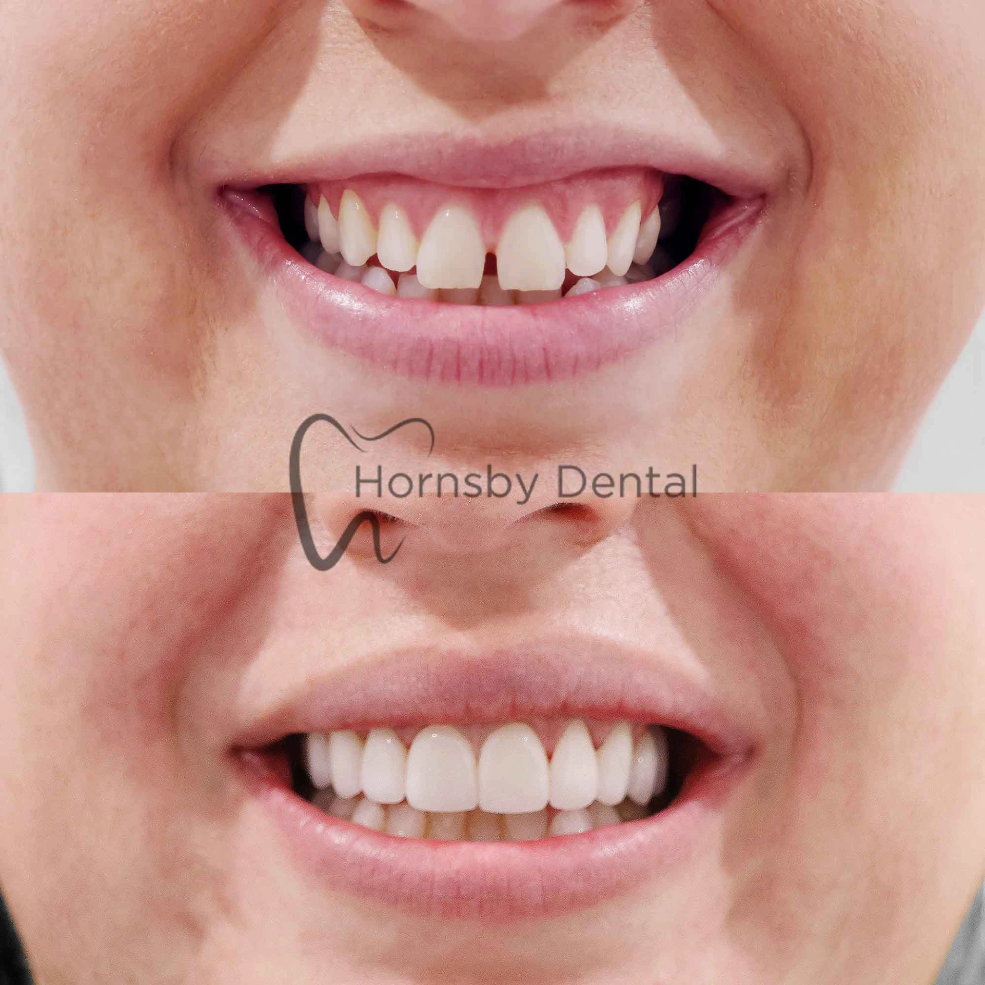 Smile Transformation
