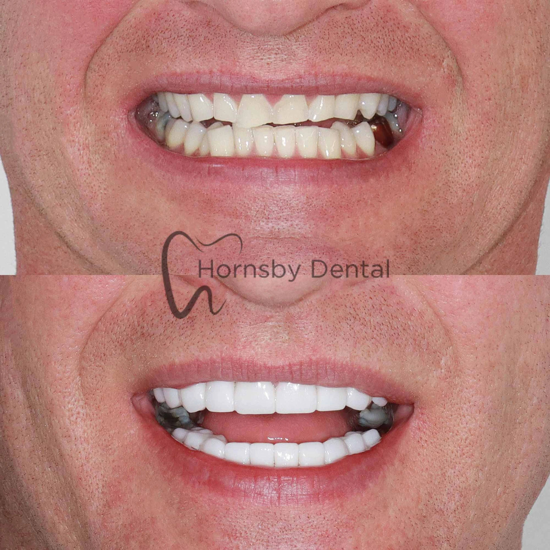 Smile Transformation