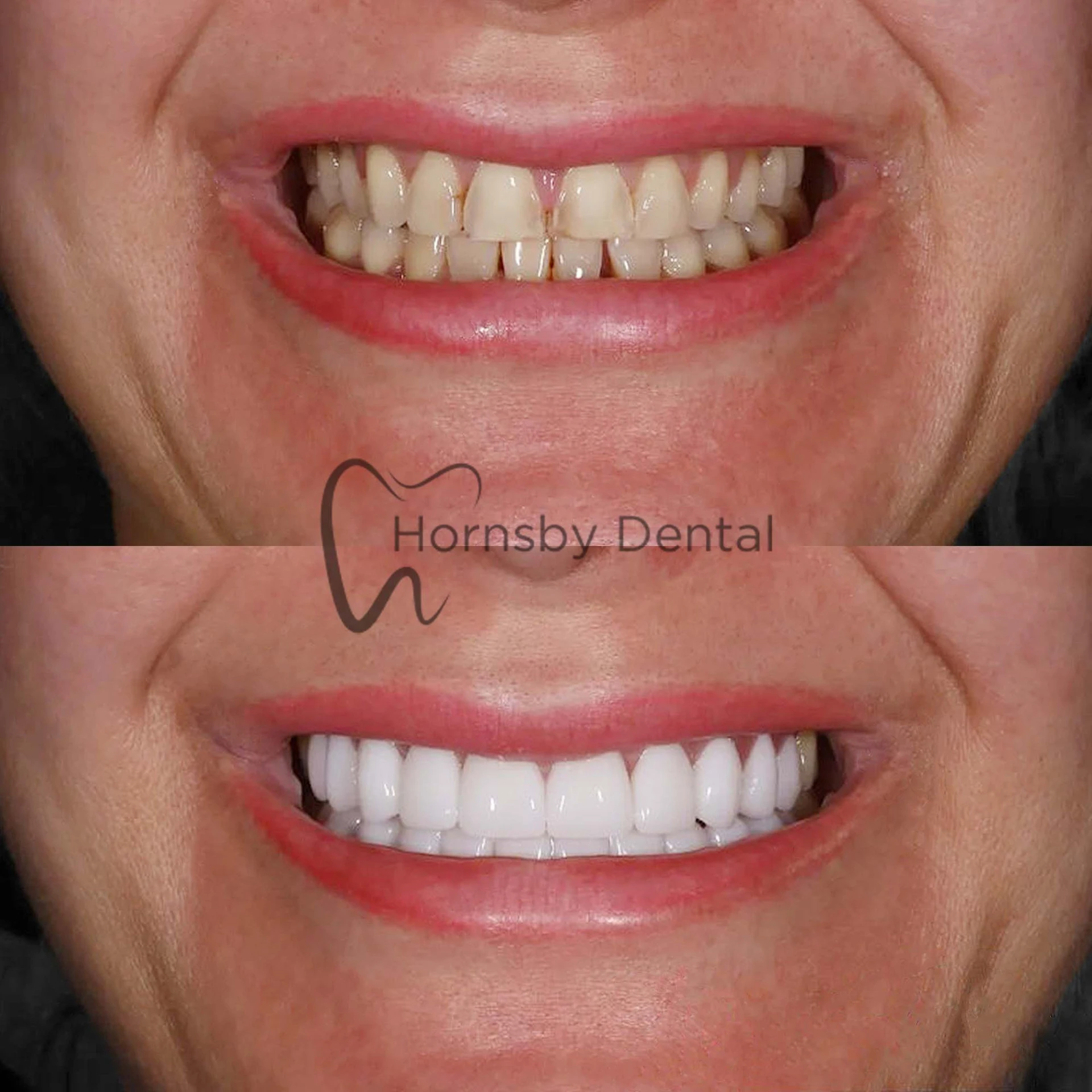 Smile Makeover
