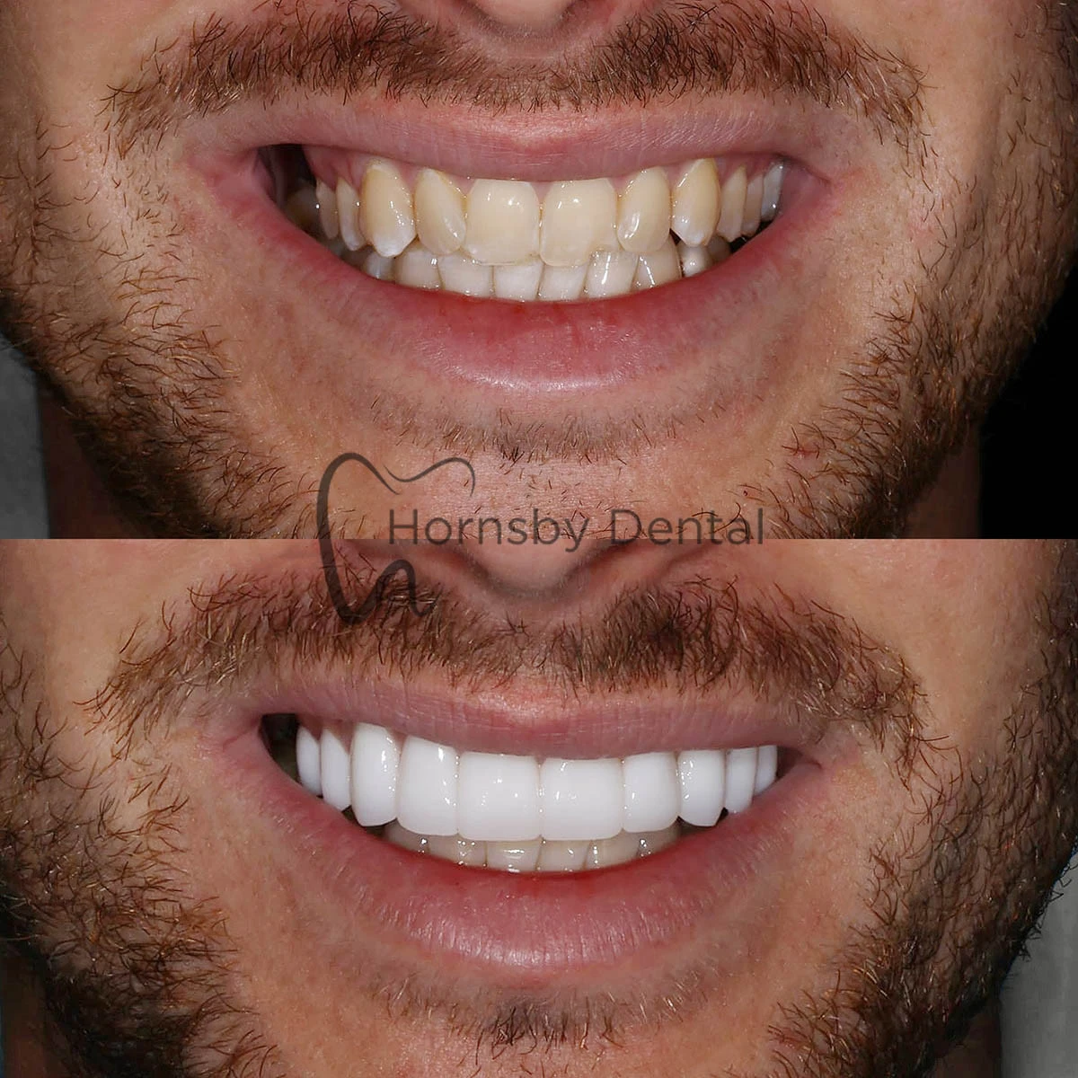 Smile Makeover