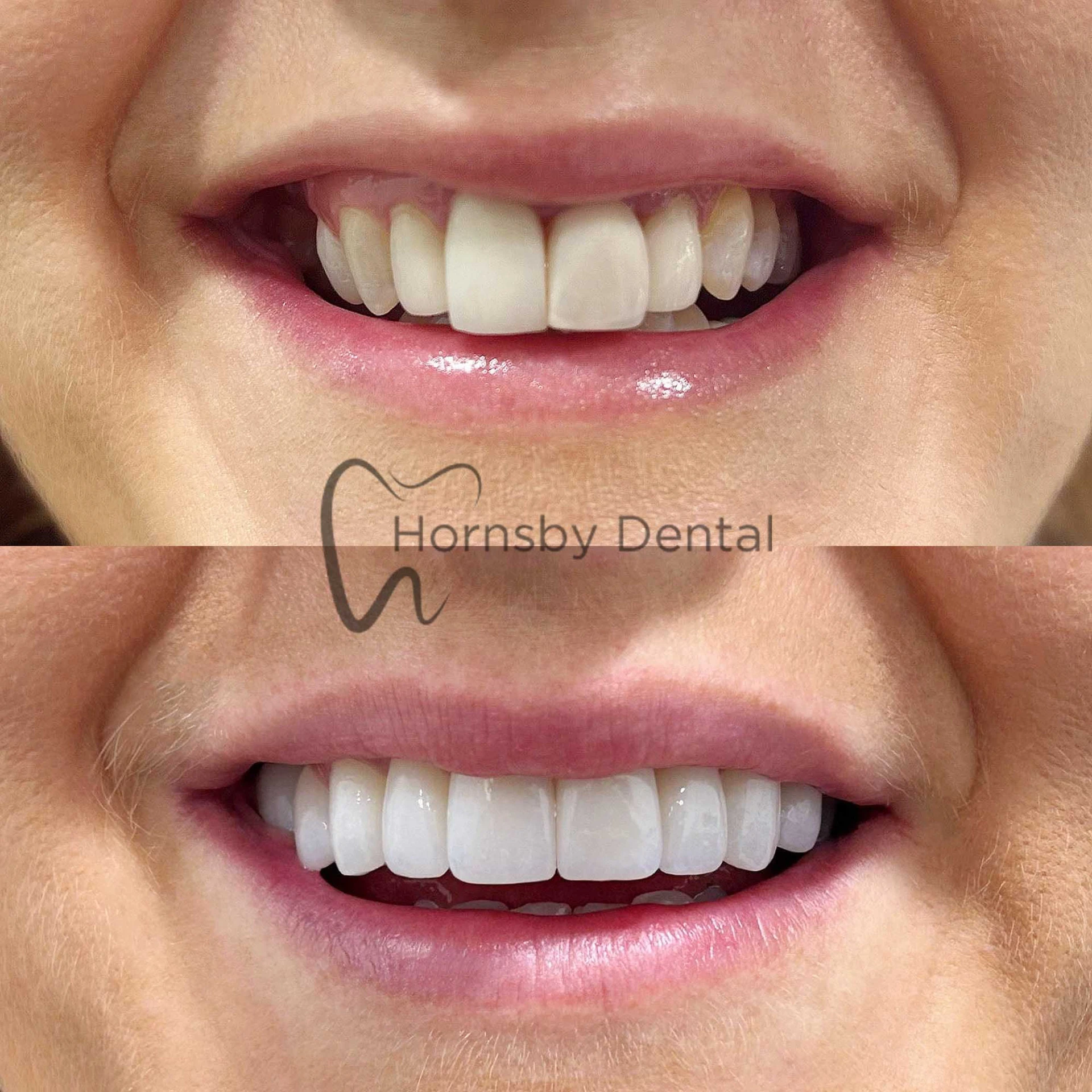 Smile Makeover