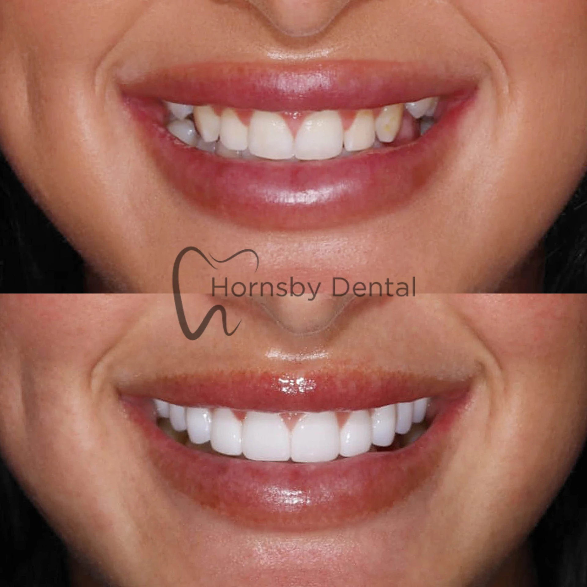 Smile Makeover