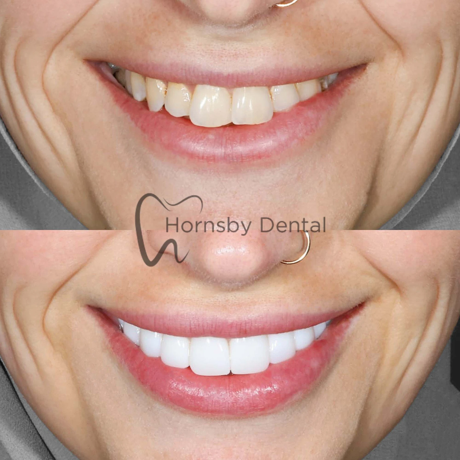 Smile Makeover