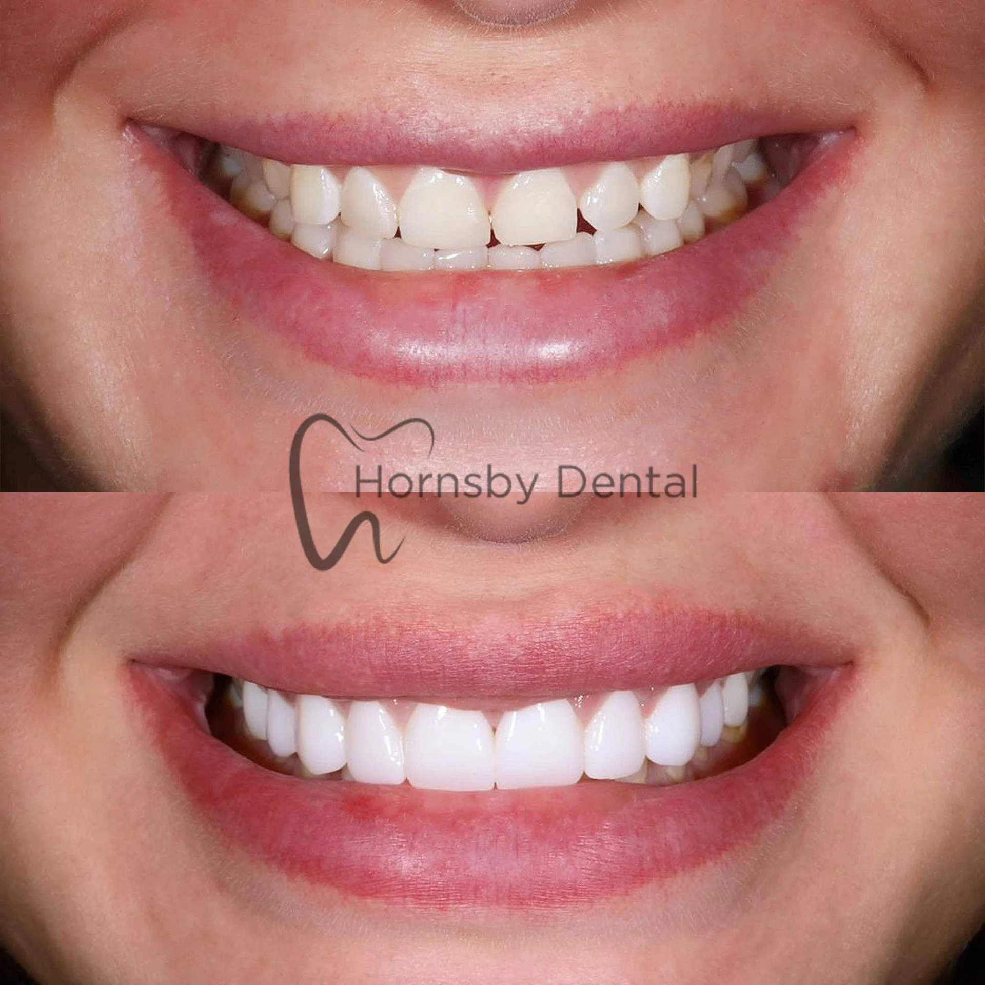 Smile Makeover