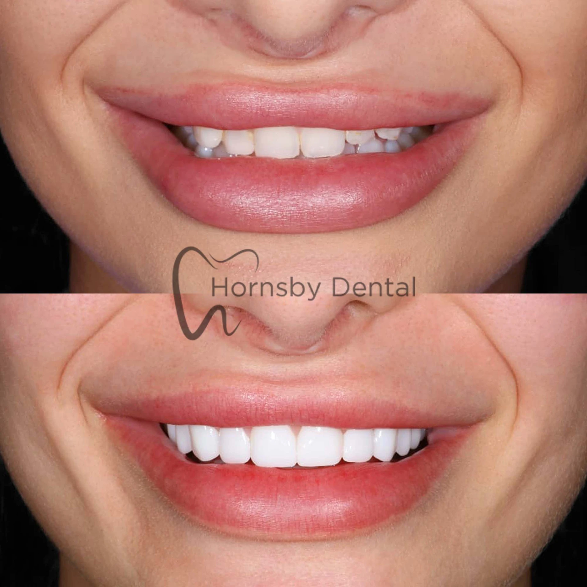 Smile Makeover