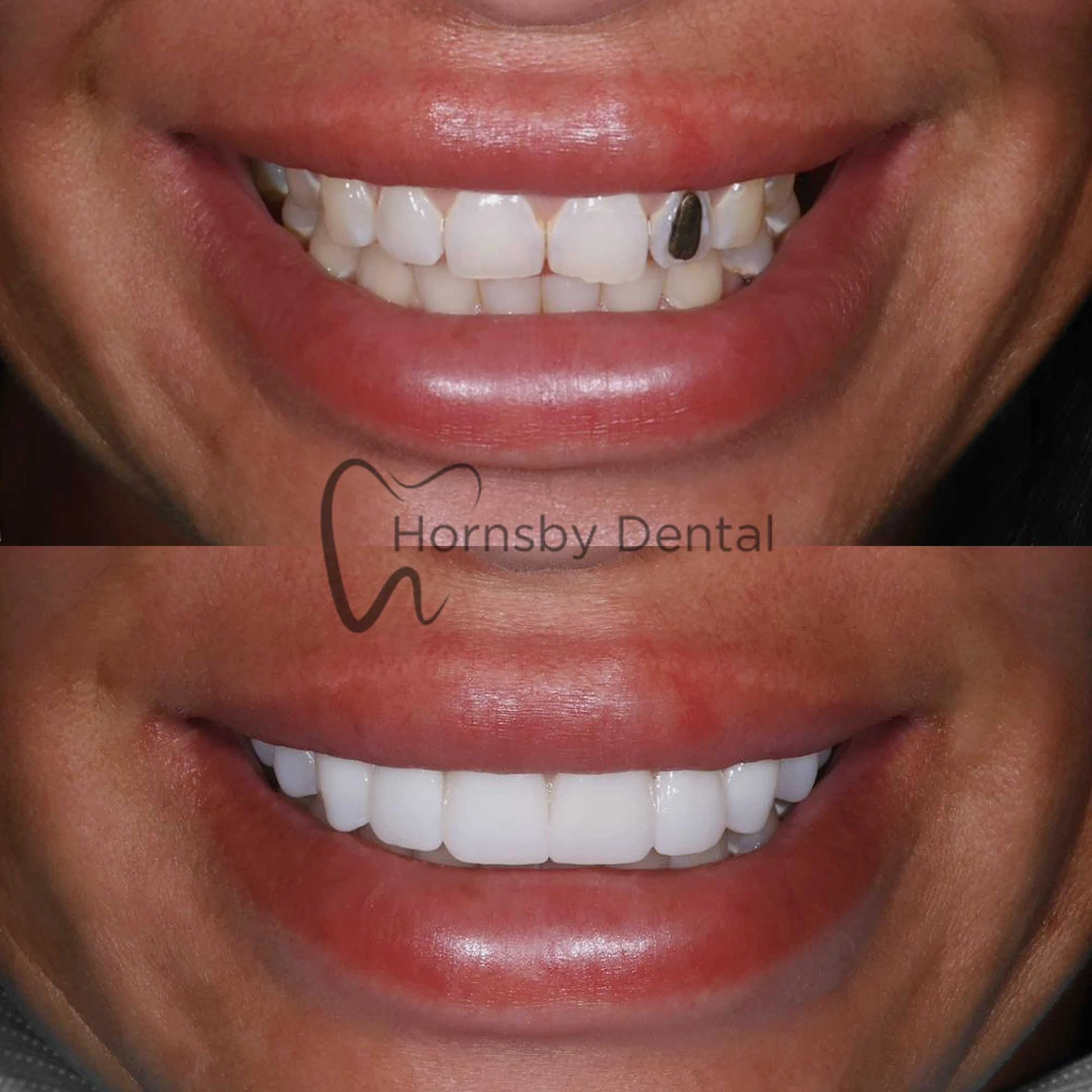 Smile Transformation