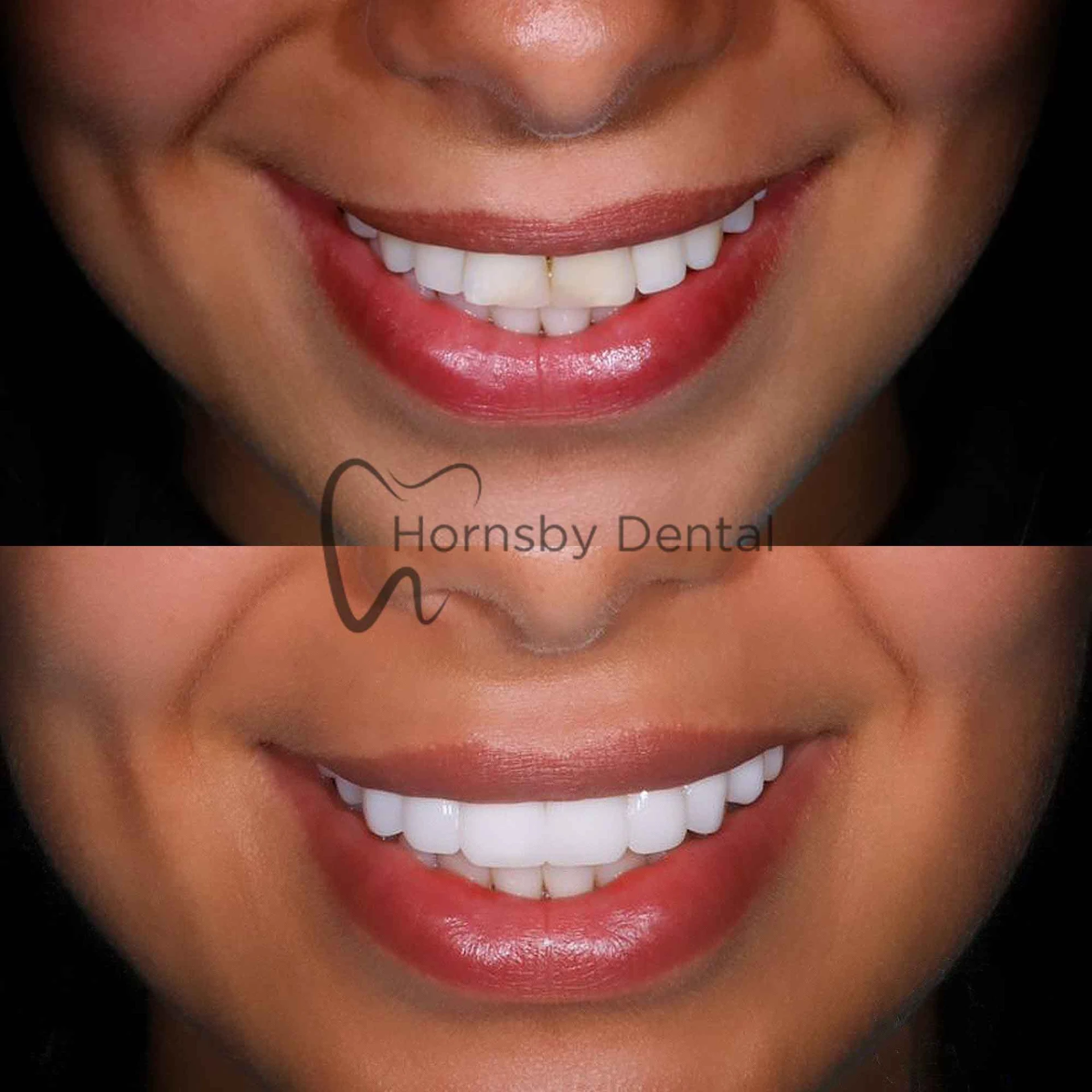 Smile Transformation