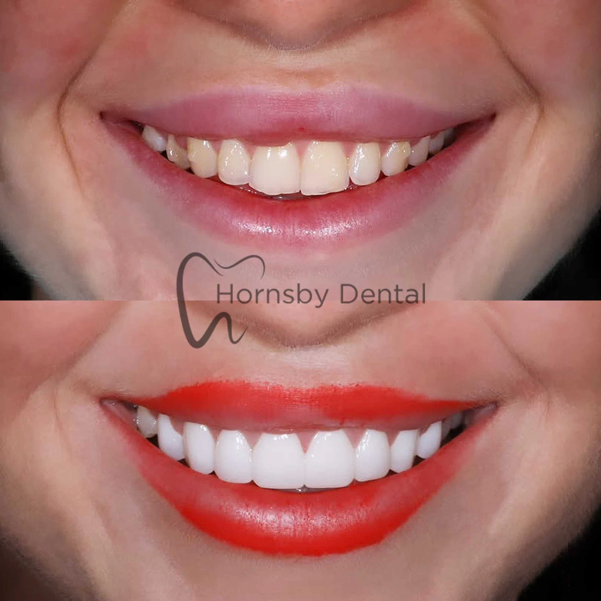 Smile Transformation