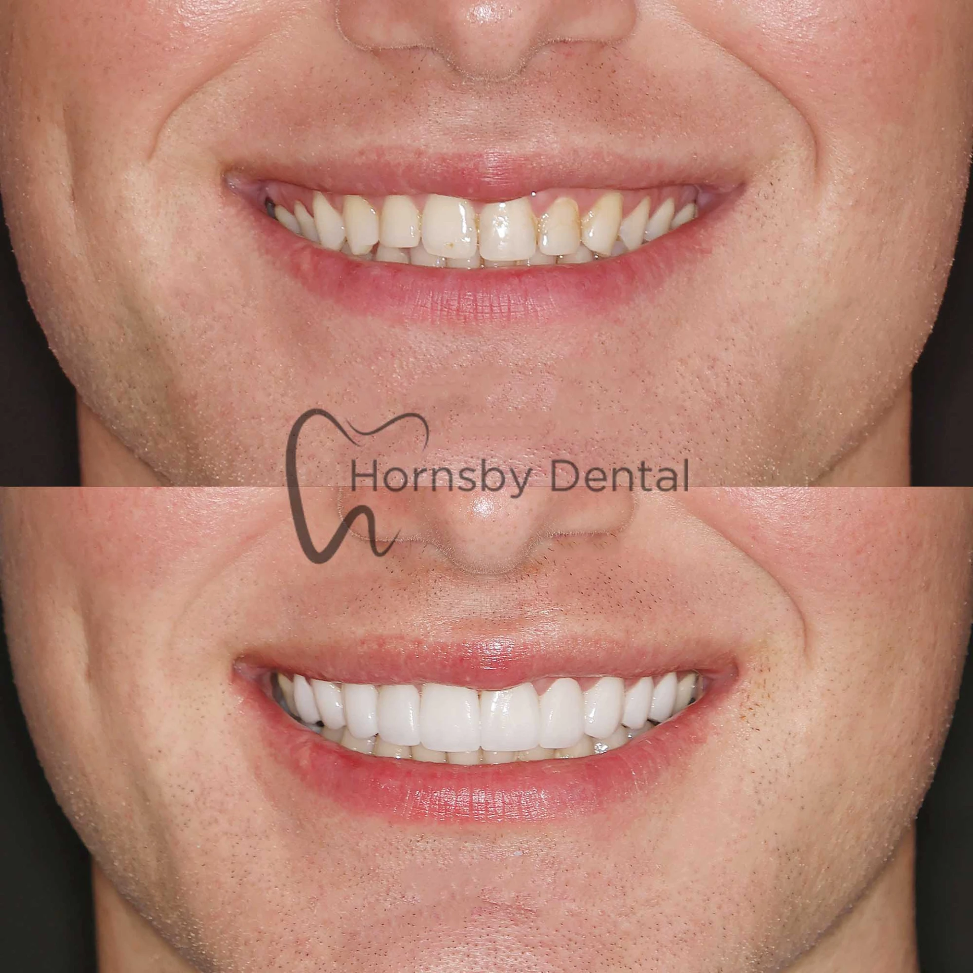 Smile Transformation