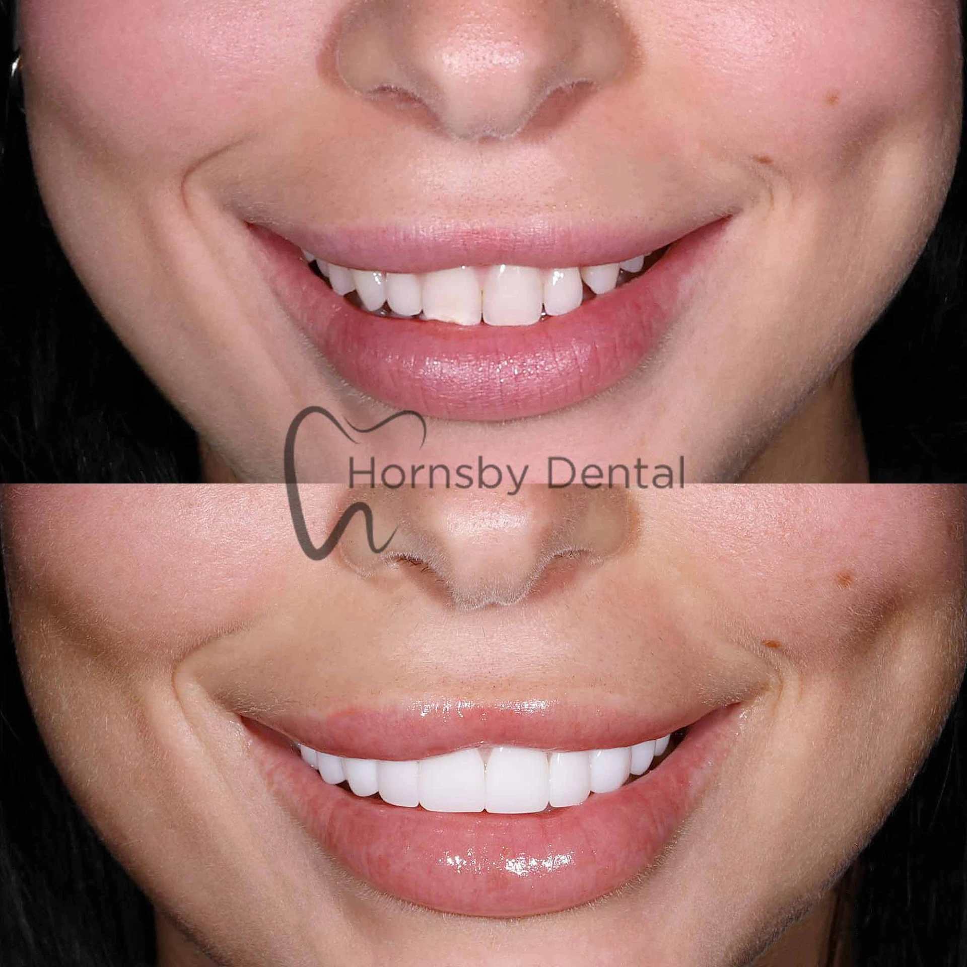 Smile Transformation