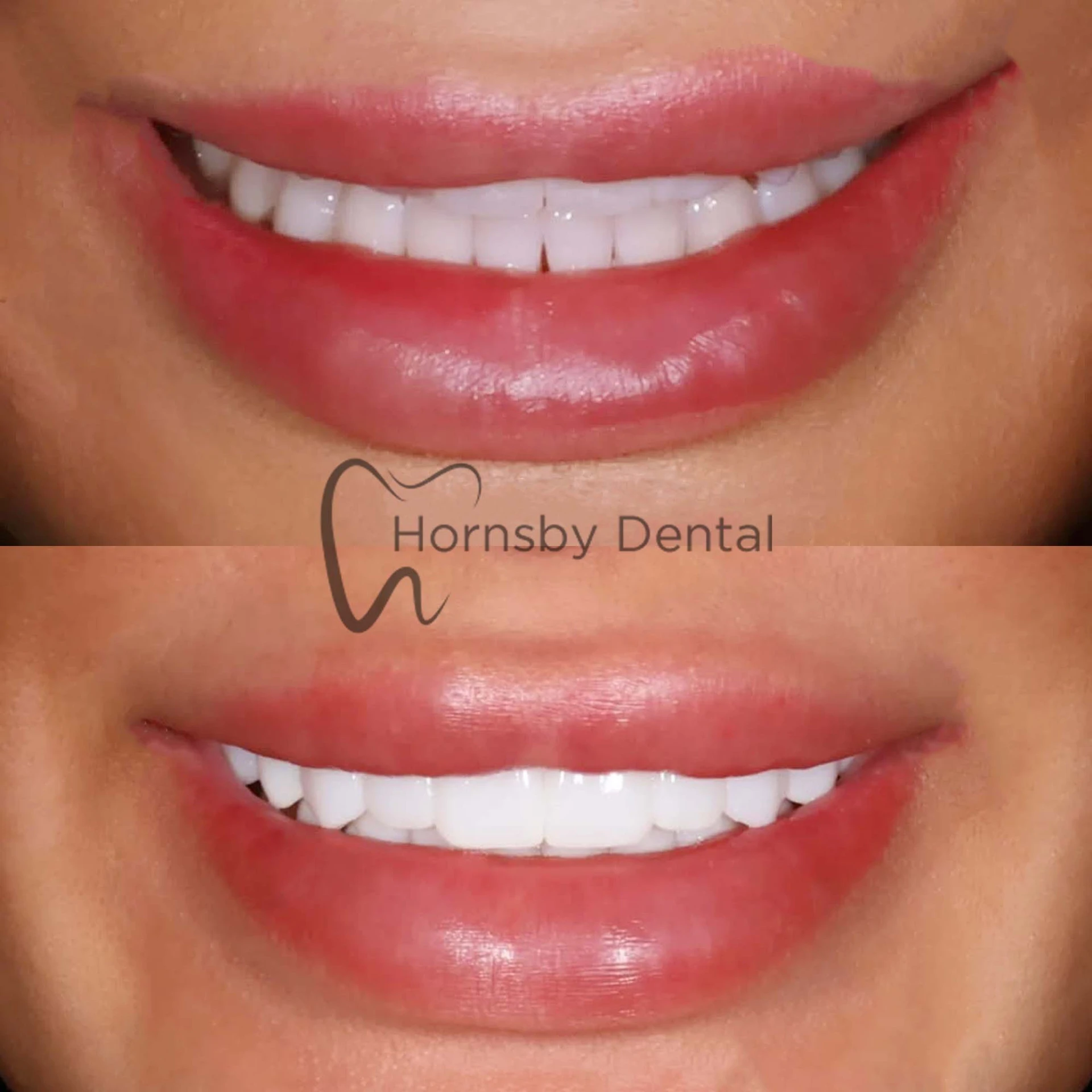 Smile Transformation