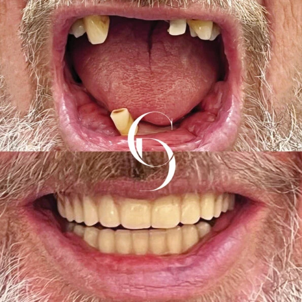 All Teeth on Implants